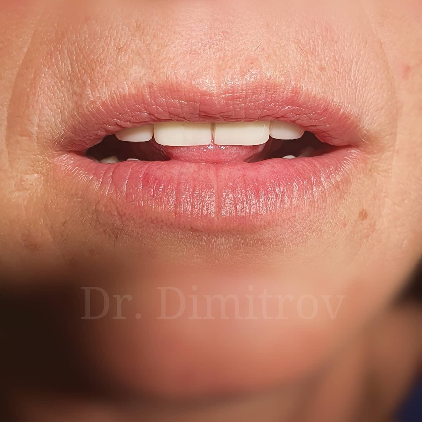 След лечение