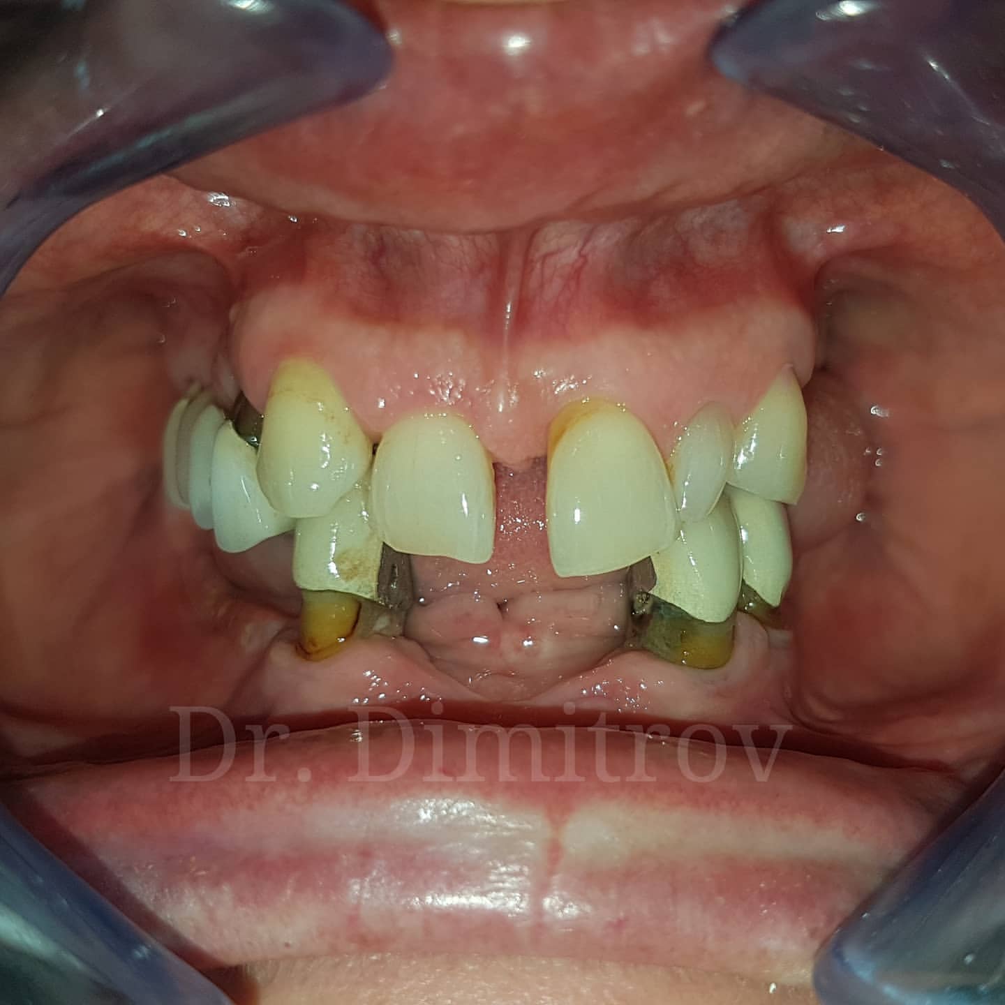 Преди лечение