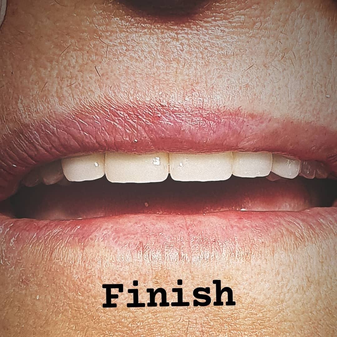 След лечение