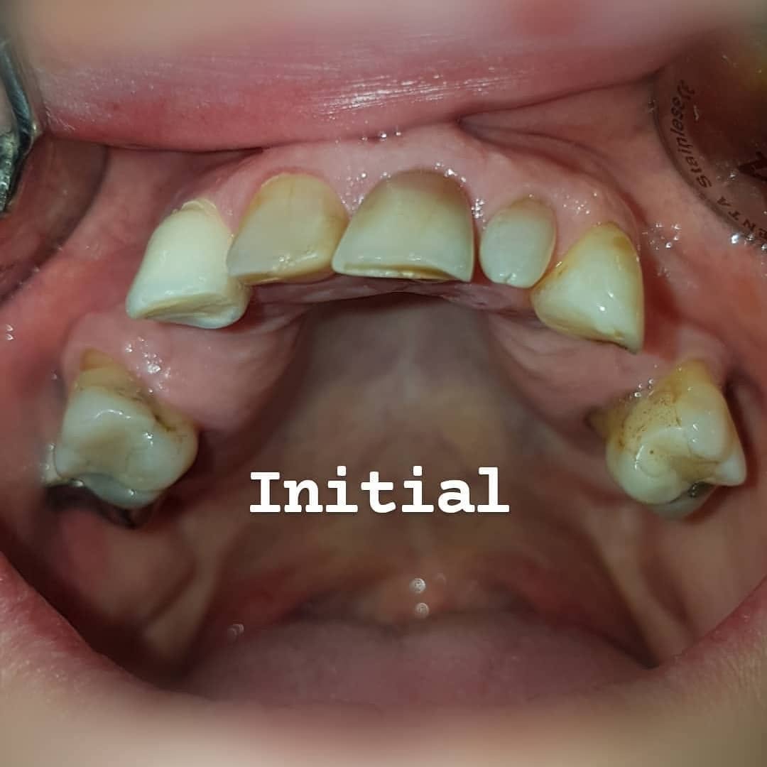 Преди лечение